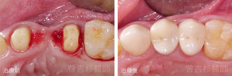 台中植牙專家+台中植牙牙醫診所推薦