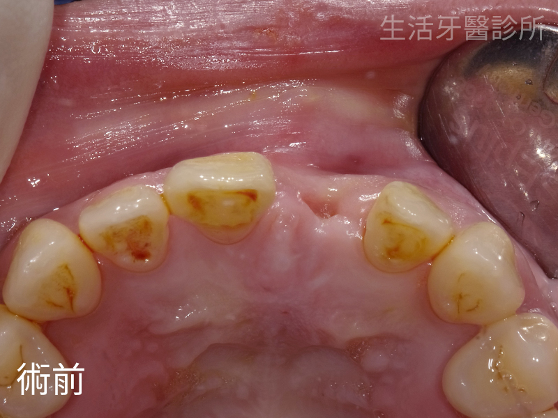 台中南屯植牙醫師牙醫推薦+牙齒斷裂植牙+台中植牙專科牙醫