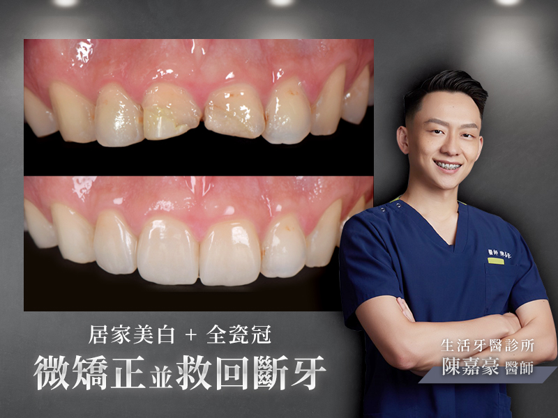 牙齒斷裂+台中植牙假牙牙醫推薦+牙根裂掉