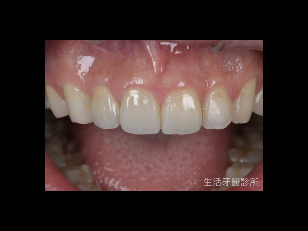 台中植牙牙醫推薦+門牙植牙+牙根牙齒斷裂