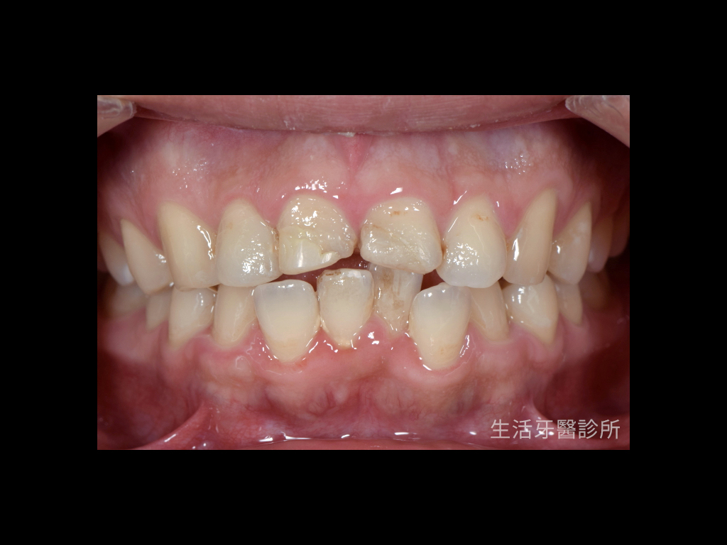 台中植牙牙醫推薦+門牙植牙+牙根牙齒斷裂