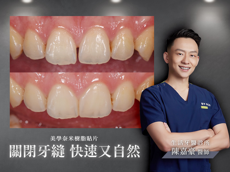 牙齒斷裂+台中假牙牙醫推薦+全瓷冠