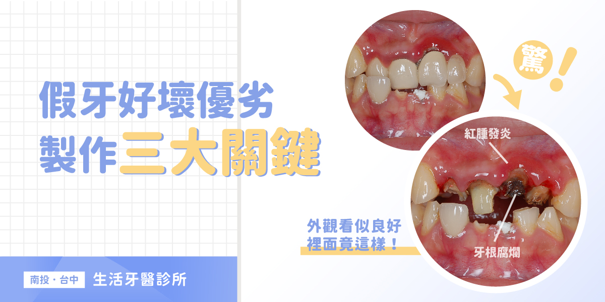 牙齒斷裂+台中假牙牙醫推薦+全瓷冠