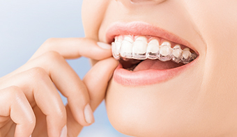台中隱適美牙齒矯正推薦生活牙醫