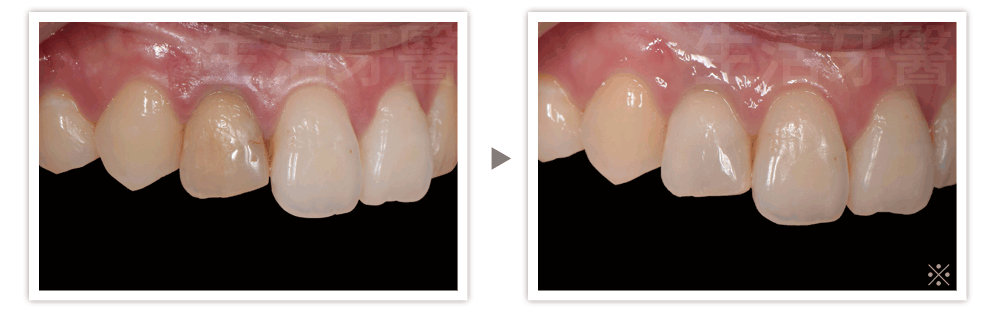 根管治療牙齒變黑,台中牙醫推薦