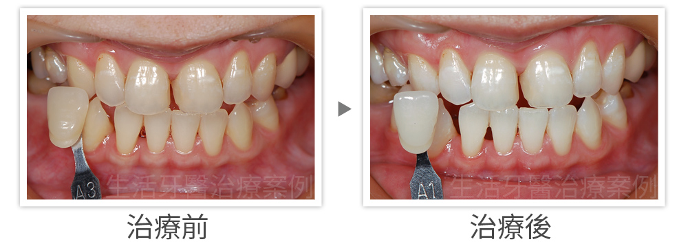 台中牙齒美白冷光美白,冷光美白實際治療案例分享照片心得,推薦生活牙醫診所