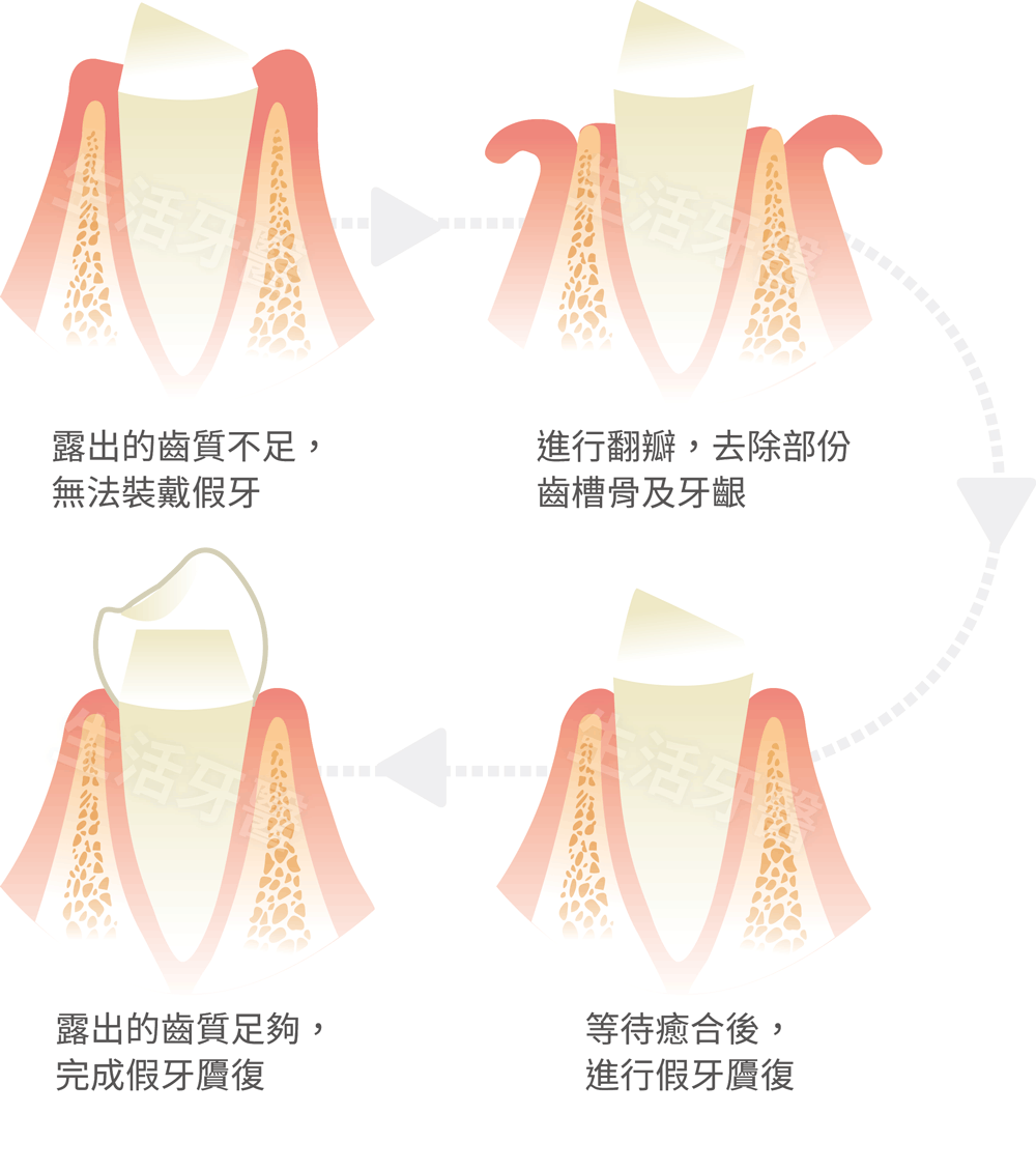 牙冠增長術