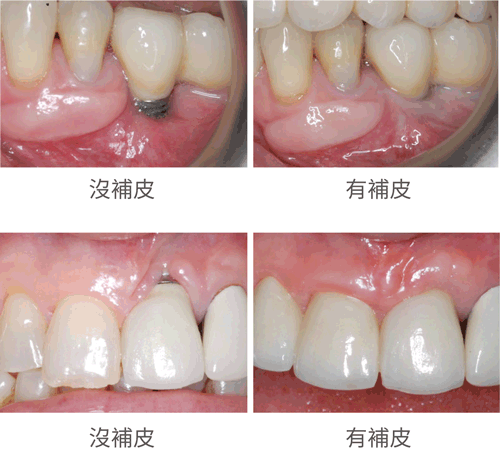 補皮,角化牙齦增生術,生活牙醫台中南投竹山