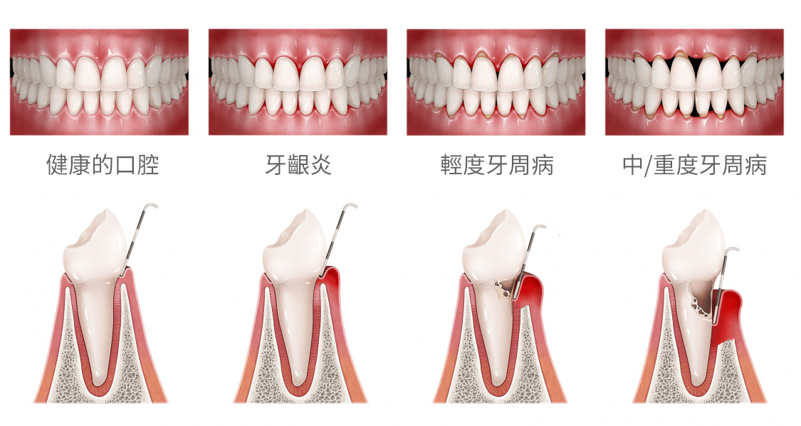 牙周病的症狀,牙周病發展過程,台中南投牙周病治療