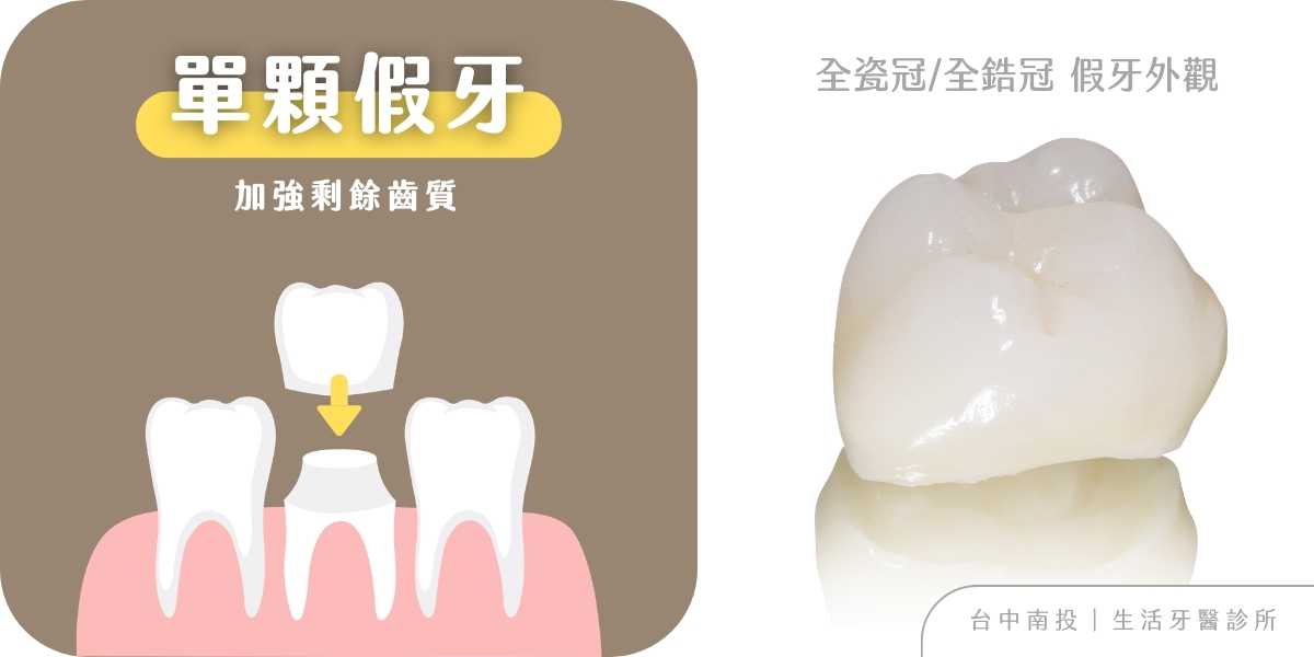 全瓷冠假牙、牙橋、活動假牙完整種類與優缺點分析+台中牙醫推薦生活牙醫