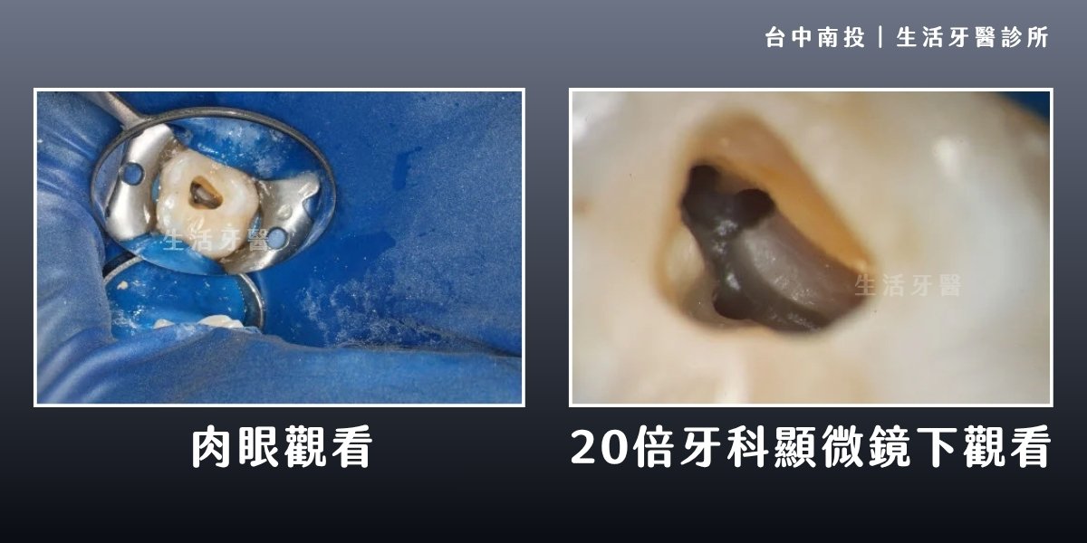 南投牙醫推薦+顯微根管治療+抽神經+重做假牙+牙裂