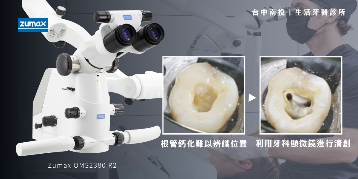 全瓷冠假牙、牙橋、活動假牙完整種類與優缺點分析+台中牙醫推薦生活牙醫